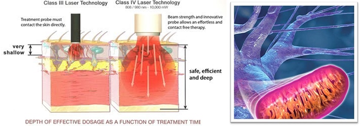 Chiropractic Athens PA Laser Therapy Chiropractic Athens PA Laser Therapy